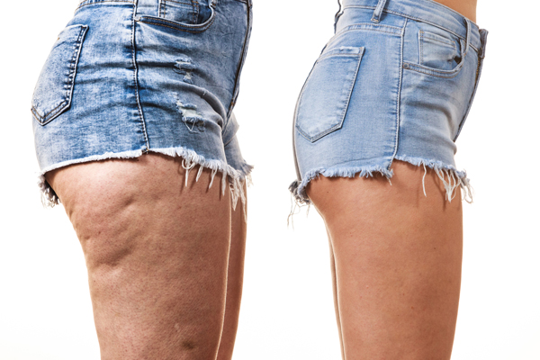 Comparaison jambes avec cellulite et sans cellulite (Istock)