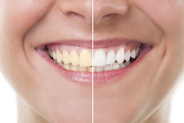 Dents blanches (iStock)